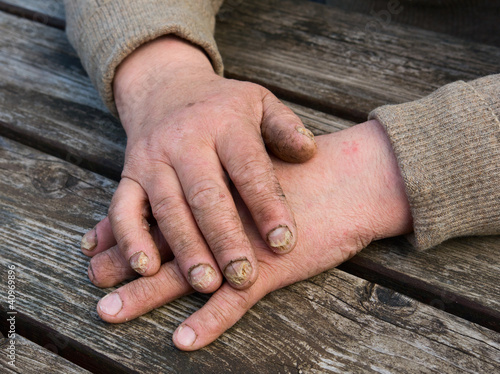 Photo: Fungal Nail Infection Fungal Nail Infection