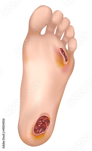 Vector: Diabetic foot. Diabetic foot.
