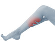 Acute pain in a woman calf