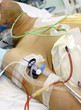 patient in the ICU. Seriously ill in bed.