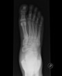 Xray piede