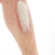 Photo: Schuppenflechte oder Psoriasis am Unterschenkel - Nahaufnahme Schuppenflechte oder Psoriasis am Unterschenkel - Nahaufnahme