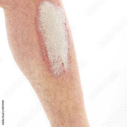 Photo: Schuppenflechte oder Psoriasis am Unterschenkel - Nahaufnahme Schuppenflechte oder Psoriasis am Unterschenkel - Nahaufnahme