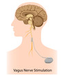 Vagus nerve stimulation therapy, eps8