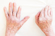 Rheumatism