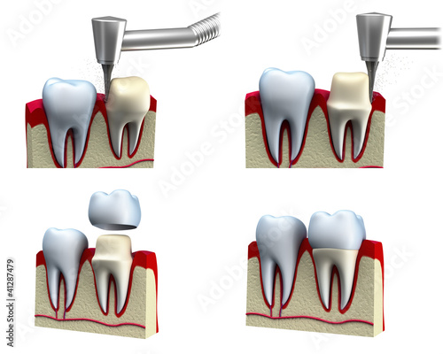 Foto: Dental crown installation process, isolated on white Dental crown installation process, isolated on white