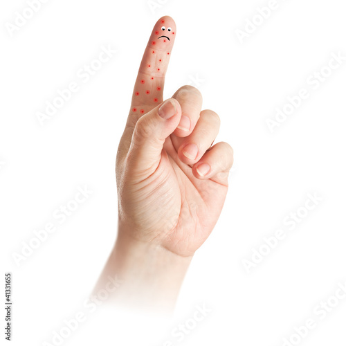 Photo: hand - hautausschlag hand - hautausschlag