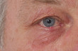 Ophtalmologie - Orgelet ou Chalazion