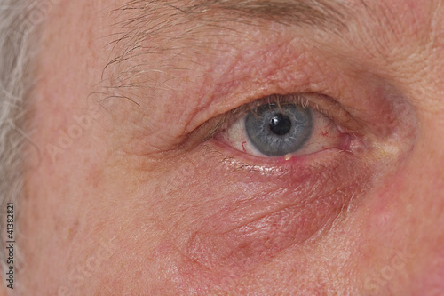 Photo: Ophtalmologie - Orgelet ou Chalazion Ophtalmologie - Orgelet ou Chalazion