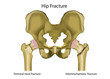hip joint fracture medical vector illustration,english