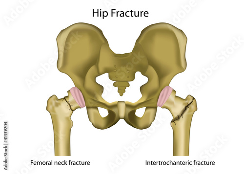 Vector: hip joint fracture medical vector illustration,english hip joint fracture medical vector illustration,english