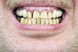 Yellow teeth  studio shot