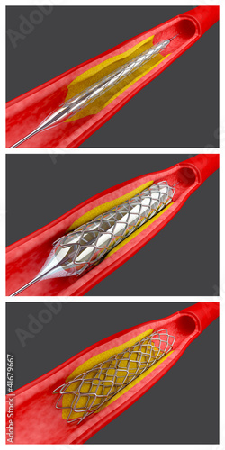 Illustration: Angioplasty Angioplasty