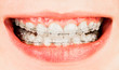 Braces