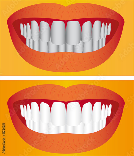 Vector: Beautiful young woman teeth before and after whitening. Beautiful young woman teeth before and after whitening.