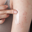 applying an emollient to dry flaky skin