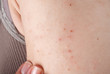 allergic rash dermatitis