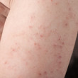 allergic rash dermatitis
