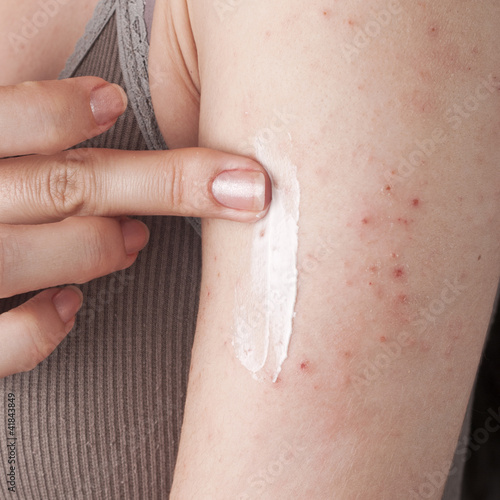 Photo: applying an emollient to dry flaky skin applying an emollient to dry flaky skin
