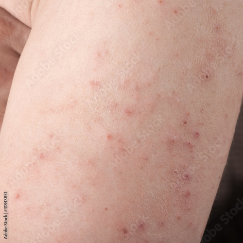 Photo: allergic rash dermatitis allergic rash dermatitis