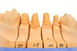 bearbeitetes dentales Gipsmodell, Frontstümpfe bearbeitetes dentales Gipsmodell, Frontstümpfe