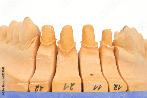 Foto: bearbeitetes dentales Gipsmodell, Frontstümpfe bearbeitetes dentales Gipsmodell, Frontstümpfe