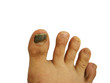Bruise on toe nail