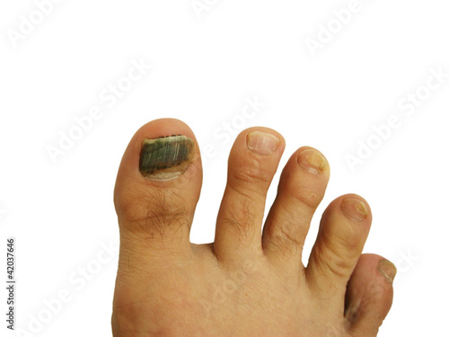 Photo: Bruise on toe nail Bruise on toe nail