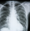 Lung X-ray