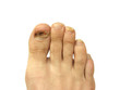 Foot with toe nail lost