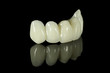 Dental Bridge