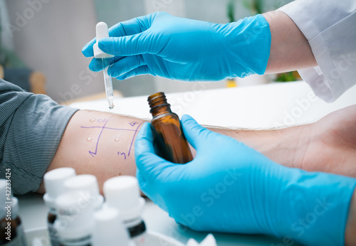 Foto: Skin prick allergy test Skin prick allergy test