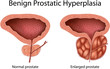 Benign prostatic hyperplasia (prostatic hypertrophy)