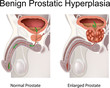 Benign prostatic hyperplasia (prostatic hypertrophy)