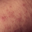 eczema atopic dermatitis symptom skin texture