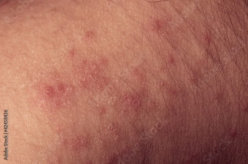 Photo: eczema atopic dermatitis symptom skin texture eczema atopic dermatitis symptom skin texture