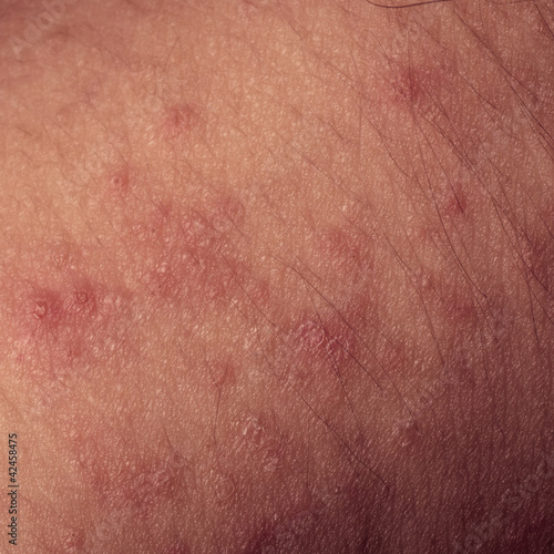 Photo: eczema atopic dermatitis symptom skin texture eczema atopic dermatitis symptom skin texture