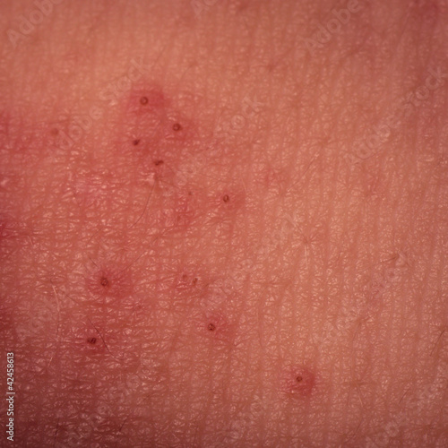 Photo: eczema atopic dermatitis symptom skin texture eczema atopic dermatitis symptom skin texture