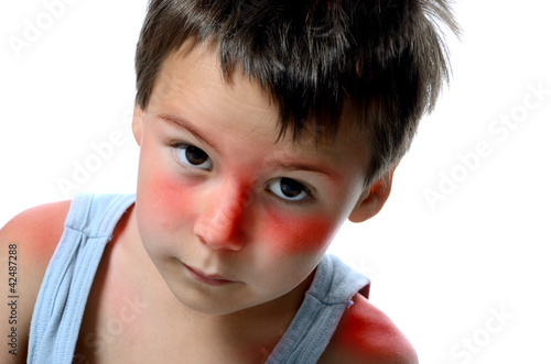 Photo: Junge mit Sonnenbrand Junge mit Sonnenbrand