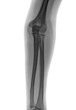 Illustration: Elbow X-ray negative Elbow X-ray negative