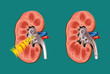Vektor: lithotripsy in kidney stones lithotripsy in kidney stones