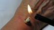 Naturheilverfahren chinesische Moxibustion