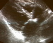Video: ultrasound scan of childs heart ultrasound scan of childs heart