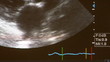 Video: ultrasound scan of childs heart ultrasound scan of childs heart