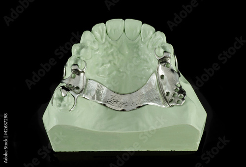 Photo: Dental Metal Framework on a Model Dental Metal Framework on a Model