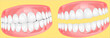 Dentures_3D_Vector Illustration.svg
