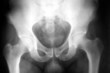 Hip xray