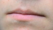 Video: teeth with brackets teeth with brackets