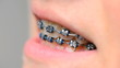 Vídeo : teeth with brackets side view teeth with brackets side view