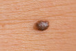 intradermal nevus